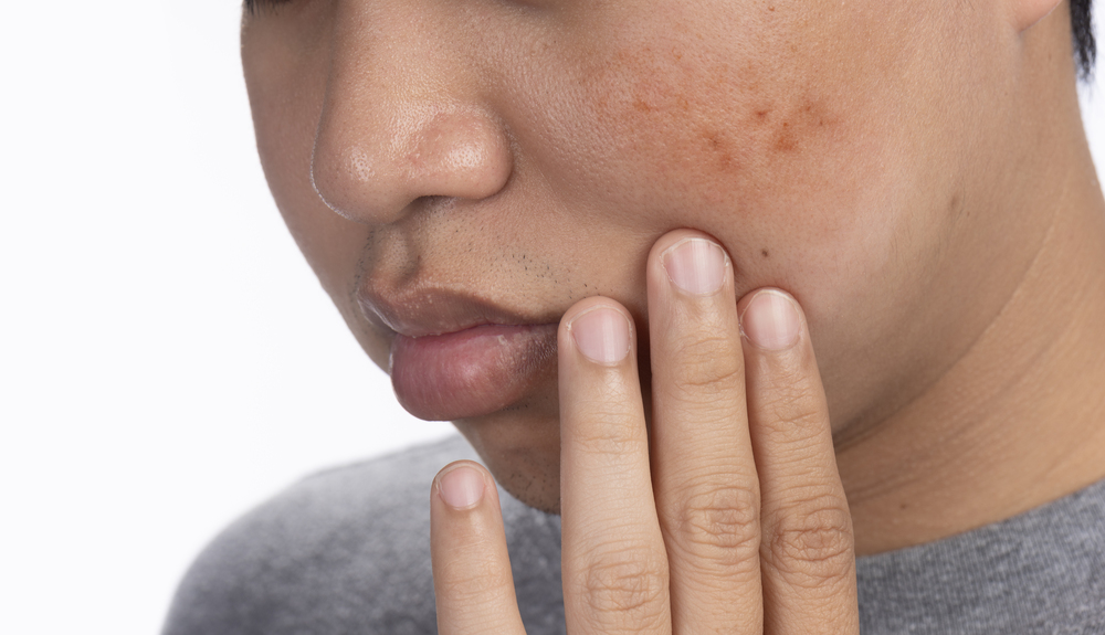 顔にできたシミ