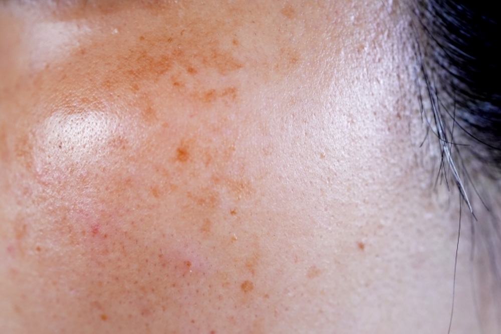 顔にできたシミ