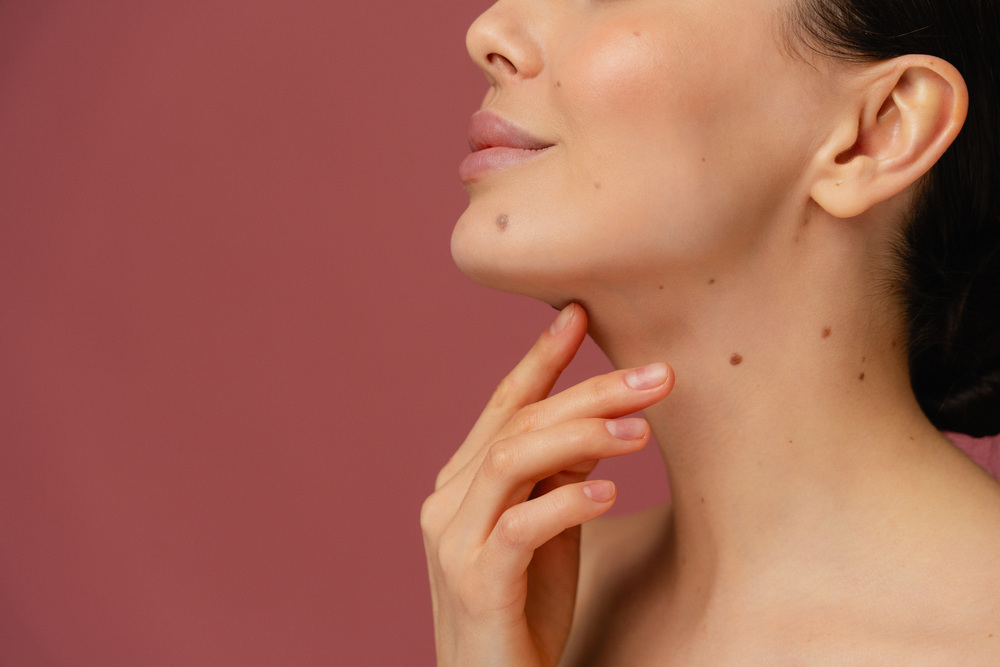 顔まわりのそばかす
