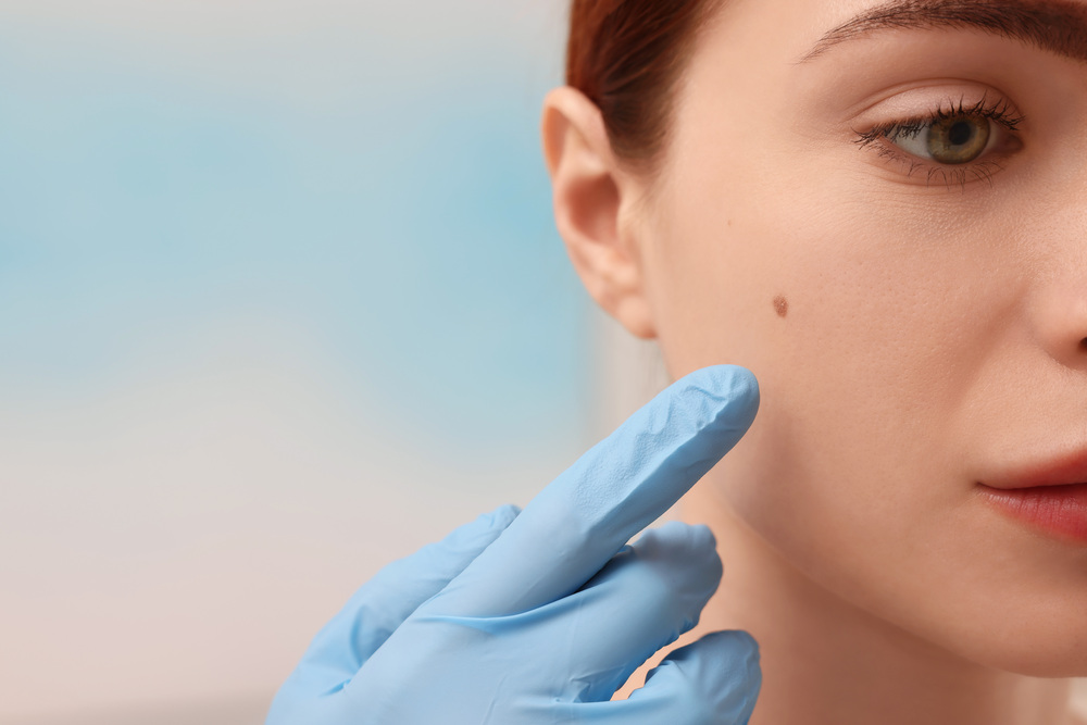 顔まわりのそばかす